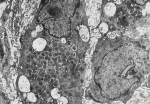 M,40y. | granular cell tumor